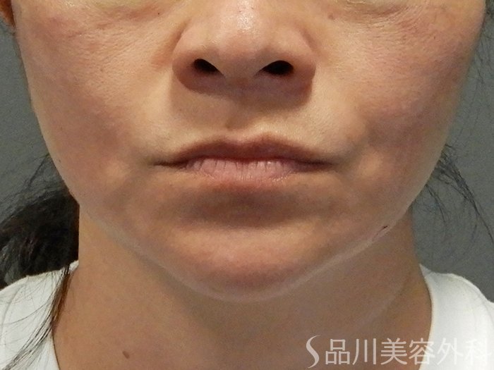 症例NO.71622のAFTER写真