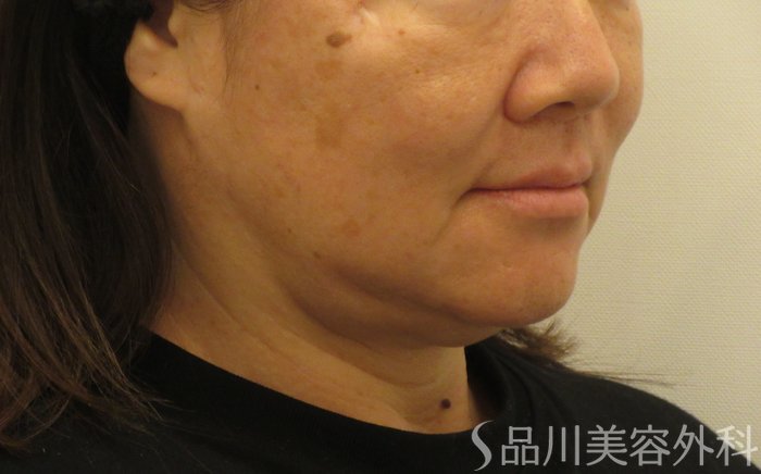 症例NO.73678のBEFORE写真