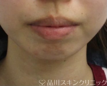 症例NO.64986のBEFORE写真