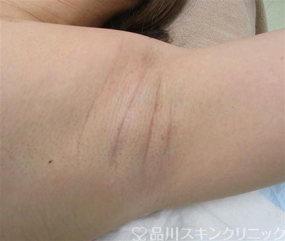 症例NO.42155のBEFORE写真
