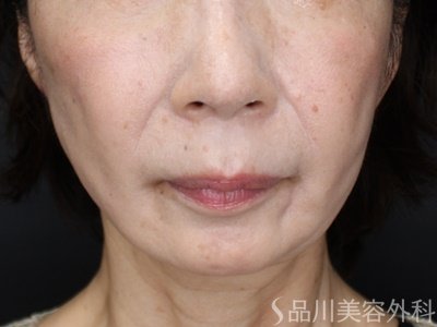 症例NO.71302のAFTER写真