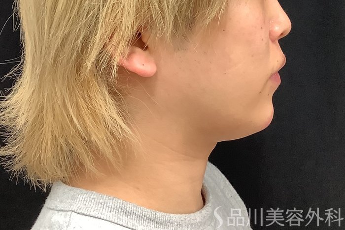 症例NO.75333のAFTER写真