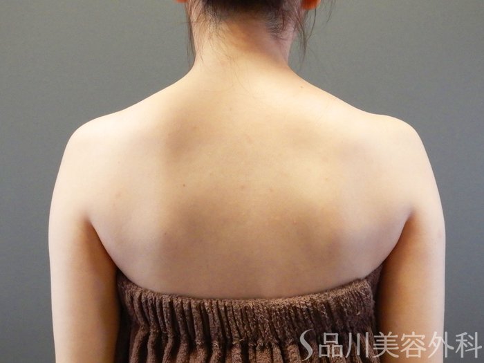 症例NO.64794のBEFORE写真