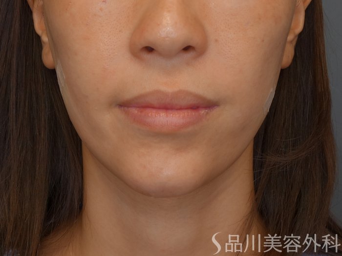 症例NO.72597のAFTER写真