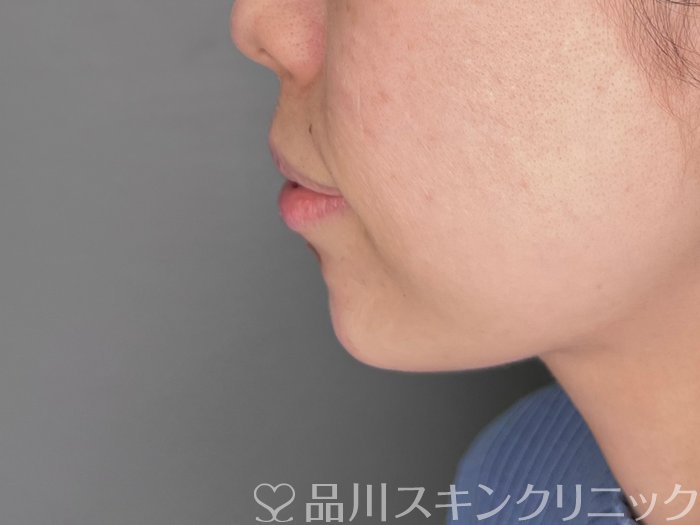 症例NO.69762のAFTER写真