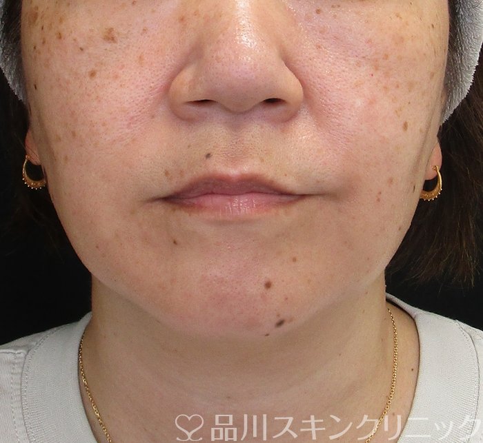 症例NO.73187のBEFORE写真