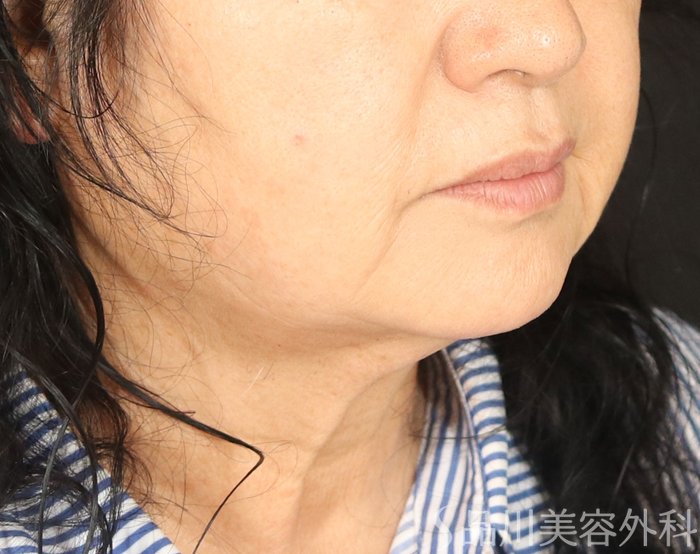 症例NO.72465のBEFORE写真