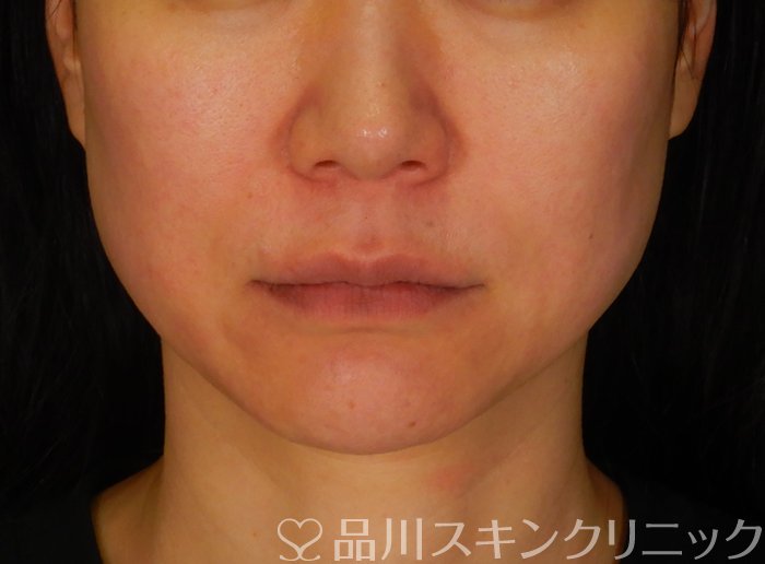 症例NO.65676のBEFORE写真