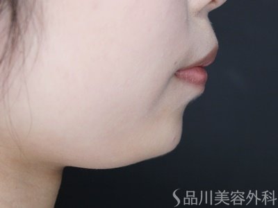 症例NO.69934のAFTER写真