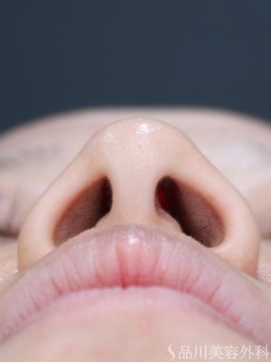 症例NO.72620のBEFORE写真