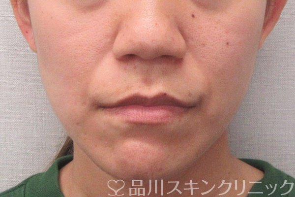 症例NO.70203のBEFORE写真