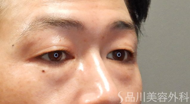 症例NO.74900のBEFORE写真