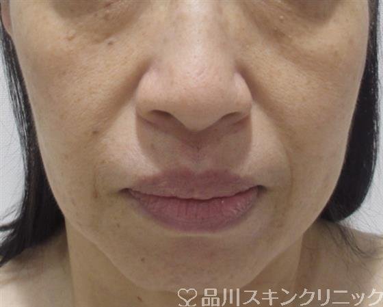 症例NO.38247のBEFORE写真
