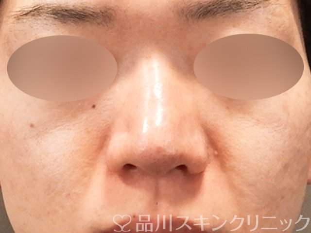 症例NO.70282のBEFORE写真