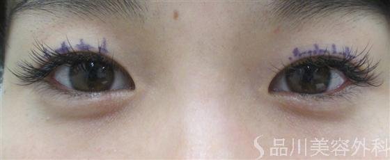 症例NO.14692のBEFORE写真