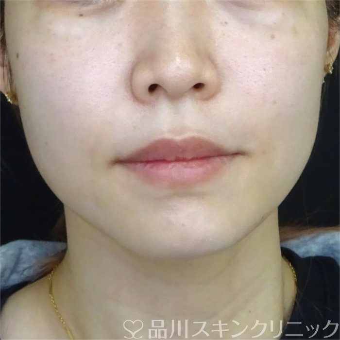 症例NO.69693のAFTER写真