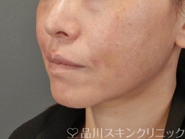 症例NO.75298のAFTER写真