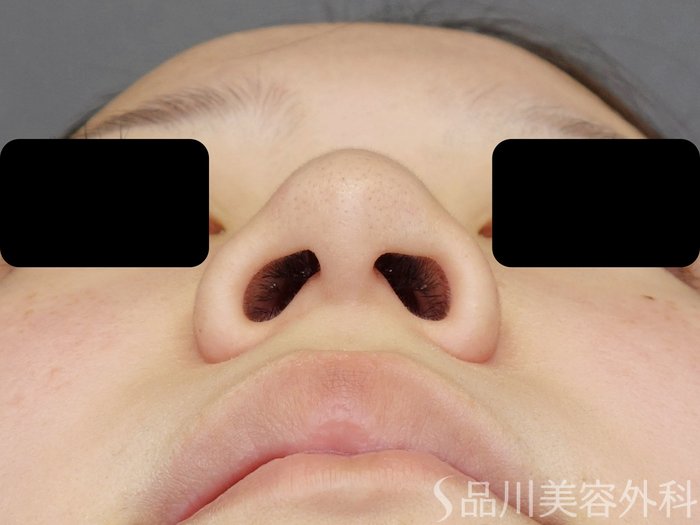 症例NO.71071のBEFORE写真