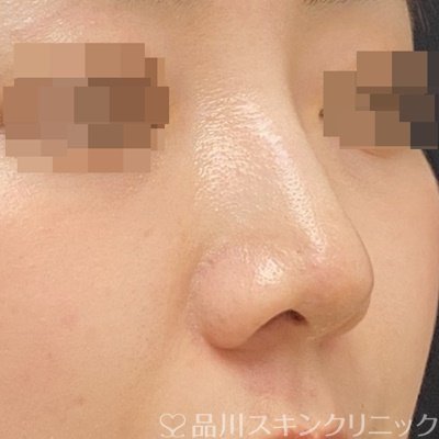 症例NO.70035のAFTER写真