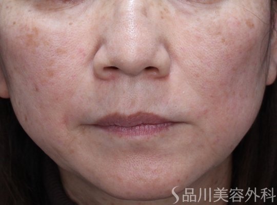 症例NO.72706のAFTER写真