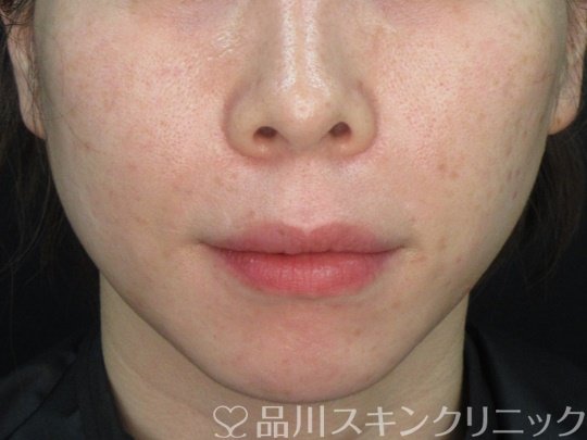 症例NO.74751のAFTER写真