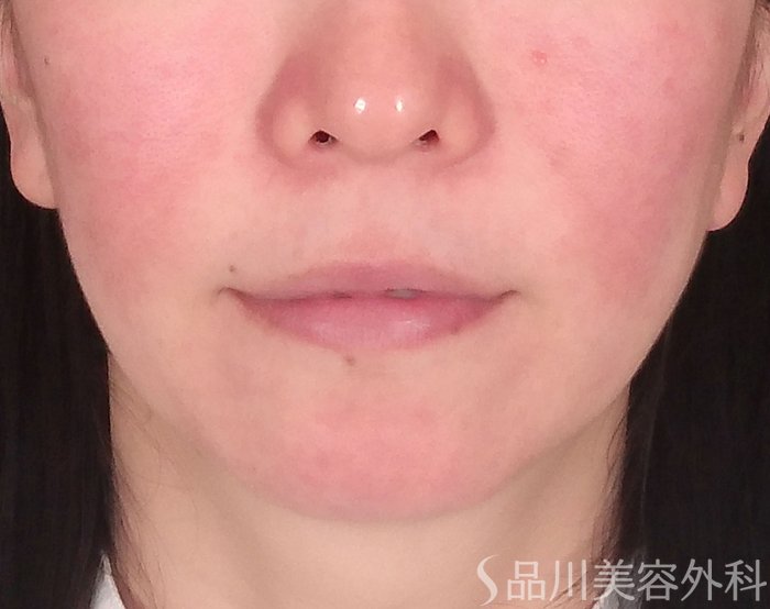 症例NO.70005のBEFORE写真