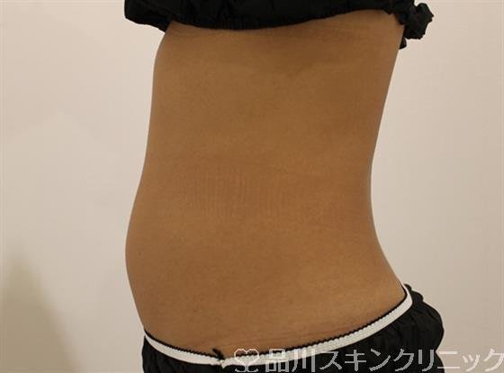 症例NO.45542のBEFORE写真