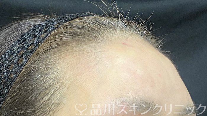 症例NO.74874のAFTER写真