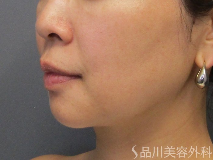 症例NO.74867のBEFORE写真