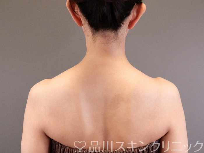 症例NO.64418のAFTER写真