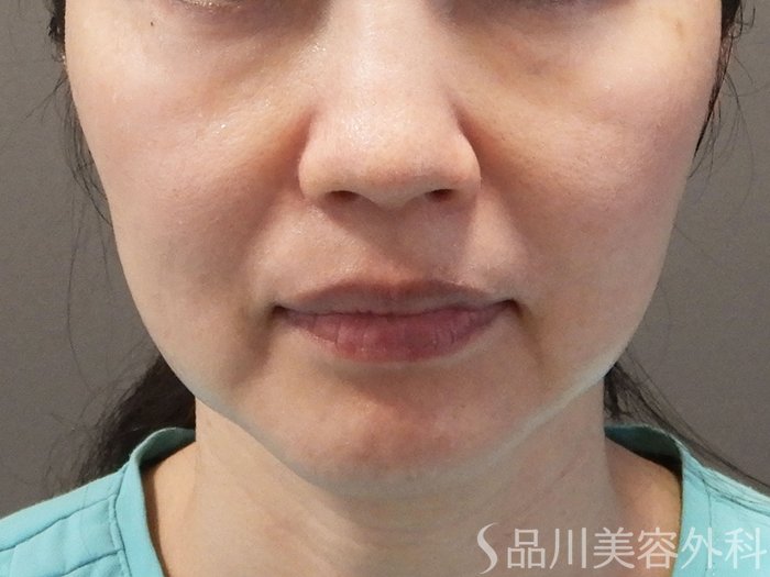 症例NO.69175のBEFORE写真