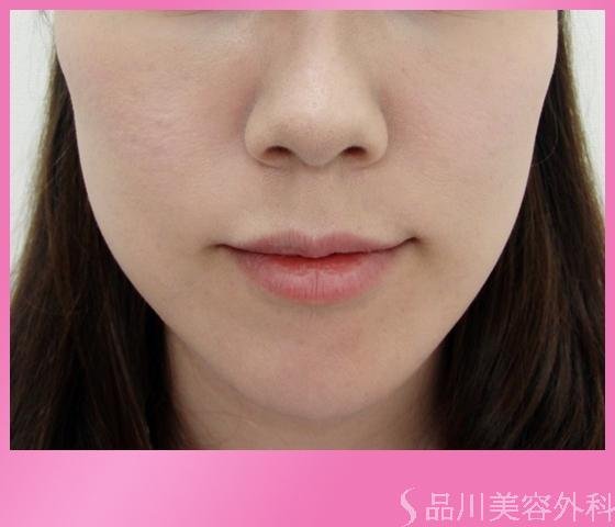 症例NO.1164のAFTER写真