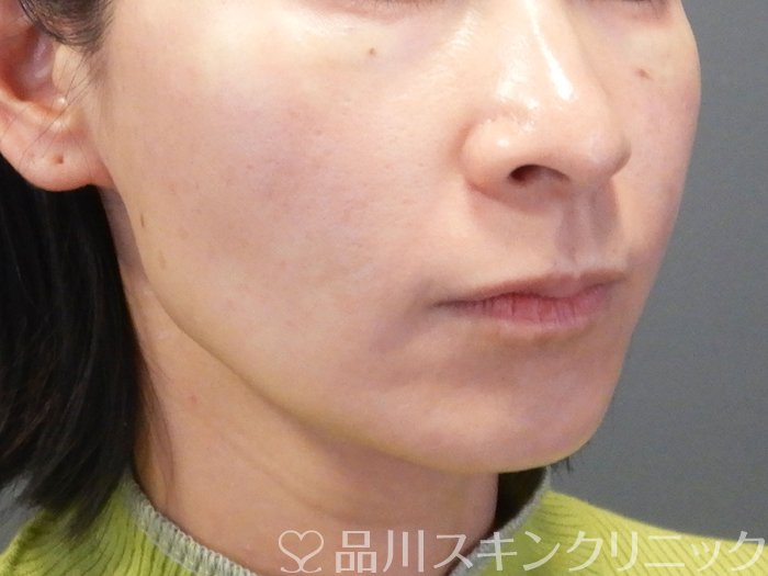症例NO.74371のAFTER写真
