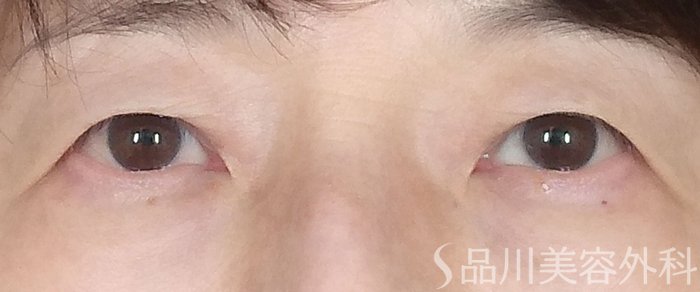 症例NO.70470のBEFORE写真