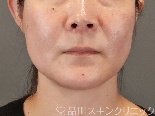 症例NO.75317のAFTER写真