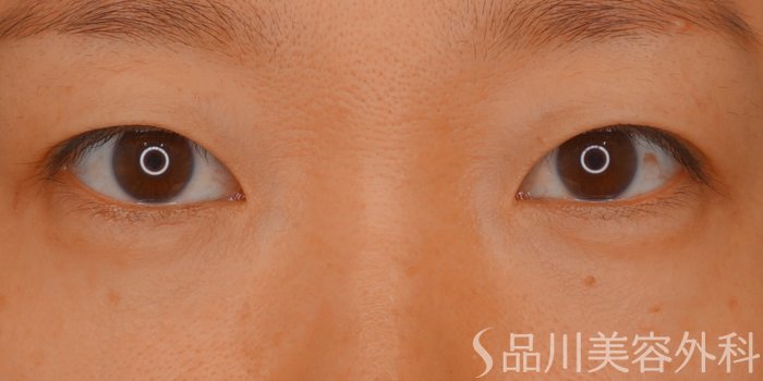 症例NO.62405のBEFORE写真