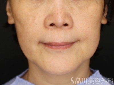 症例NO.71457のBEFORE写真