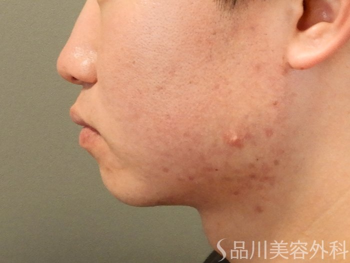 症例NO.69588のBEFORE写真