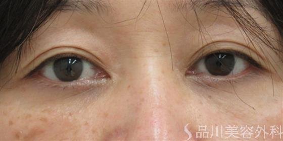 症例NO.26320のAFTER写真