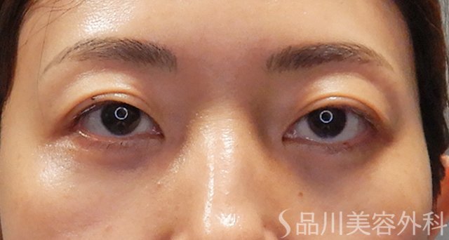 症例NO.74880のAFTER写真