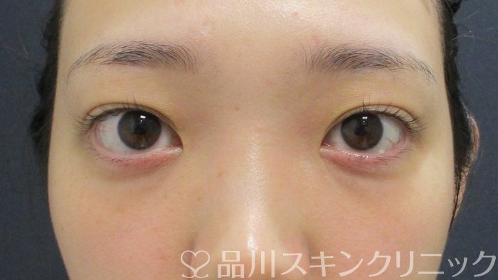 症例NO.63030のBEFORE写真