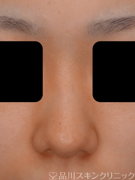 症例NO.75238のBEFORE写真