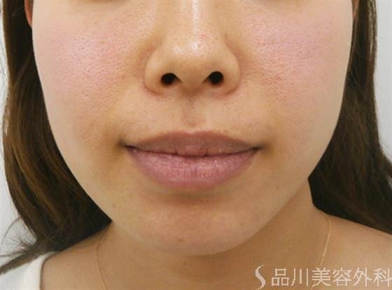 症例NO.23824のBEFORE写真