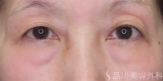 症例NO.46886のBEFORE写真