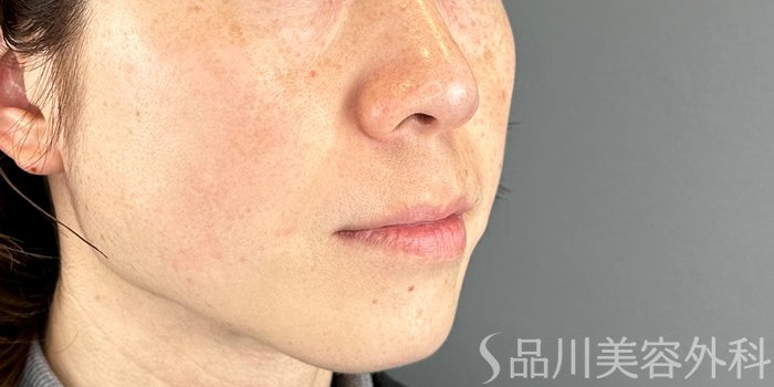 症例NO.69171のBEFORE写真