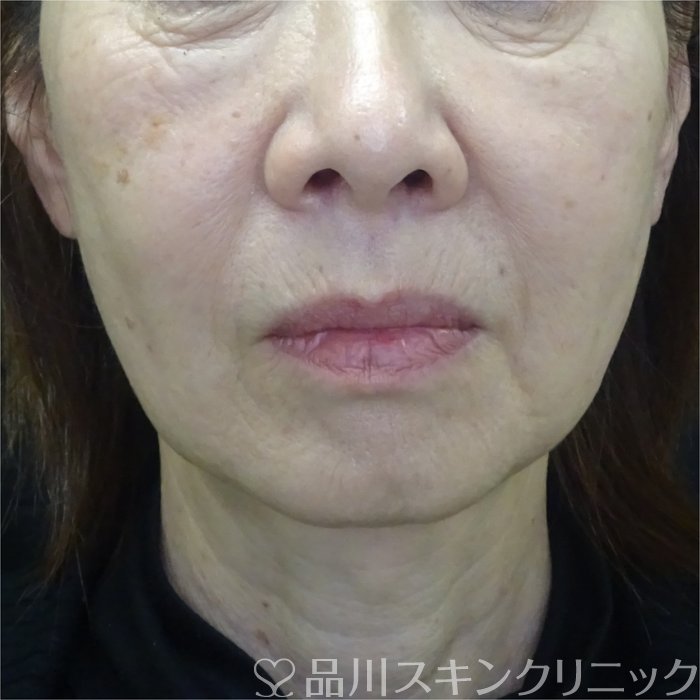 症例NO.73340のAFTER写真