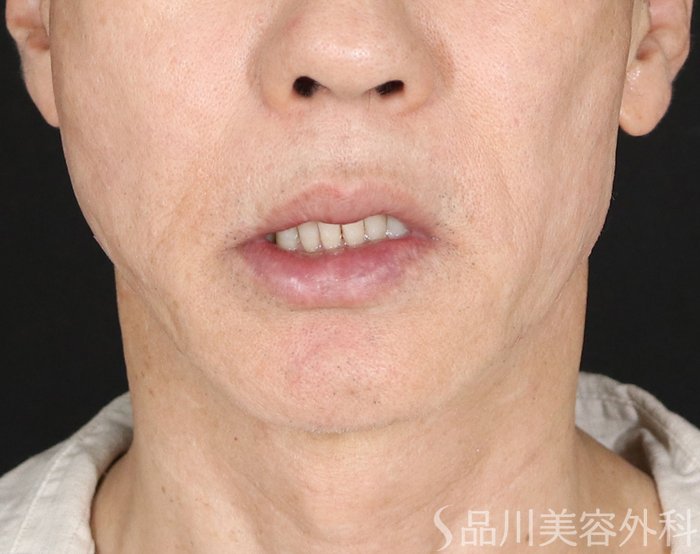 症例NO.73875のAFTER写真
