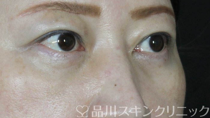 症例NO.72234のAFTER写真