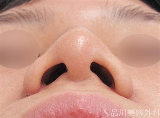 症例NO.22692のAFTER写真