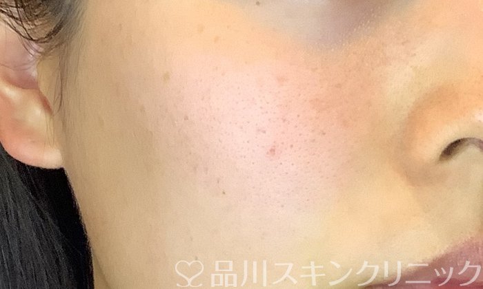 症例NO.74591のBEFORE写真